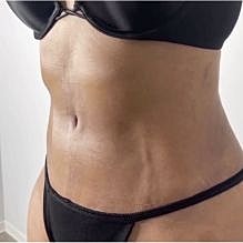 Houston body contouring patient after