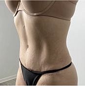 Houston body contouring patient after