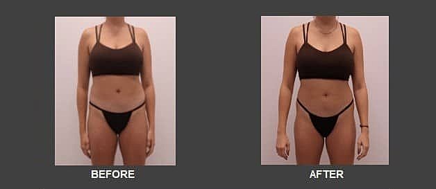 Houston Medical Weight Loss patient before and after