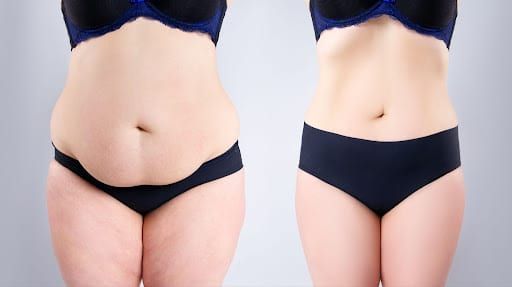 Tummy tuck