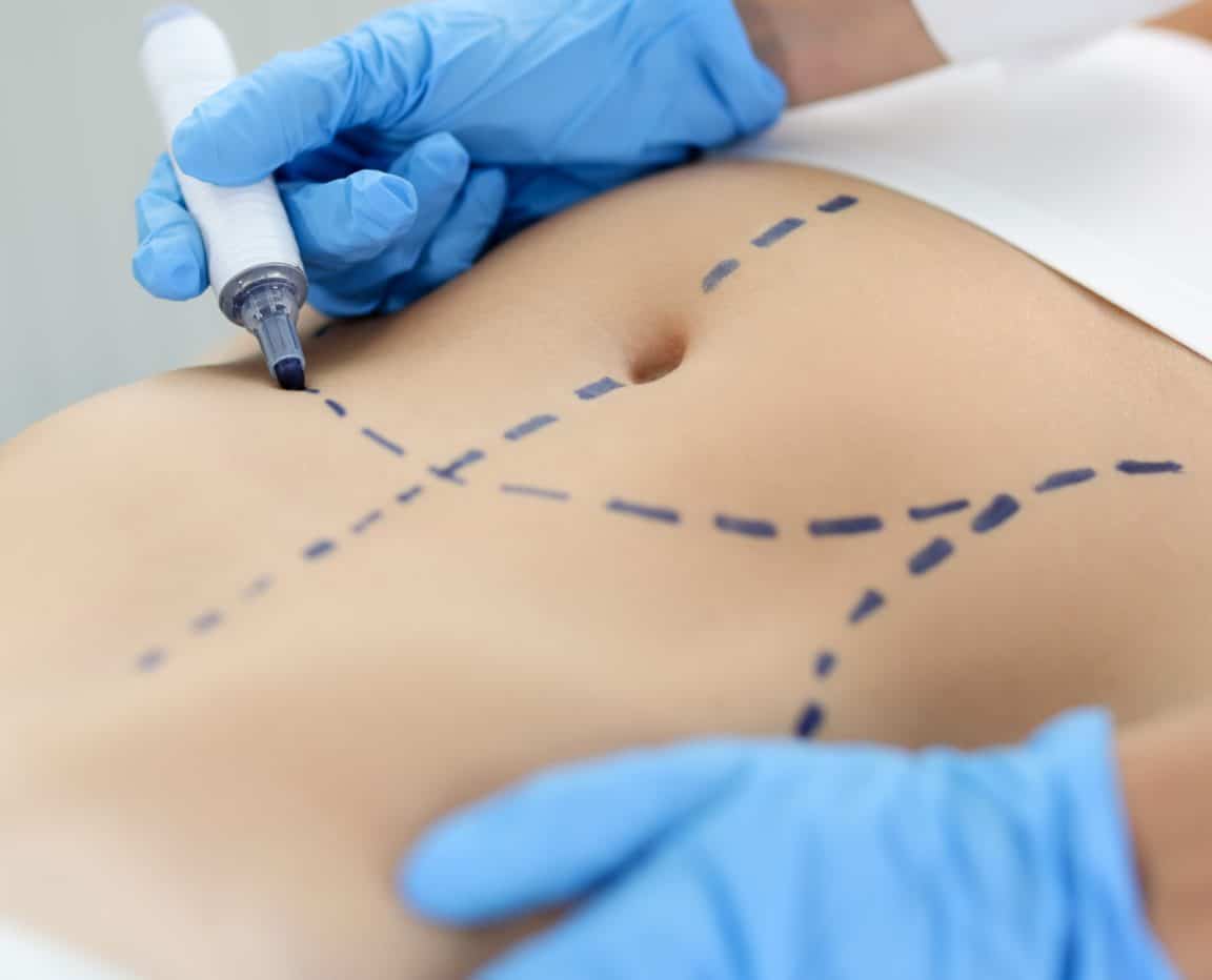 Liposuction - Body Contouring Consultation