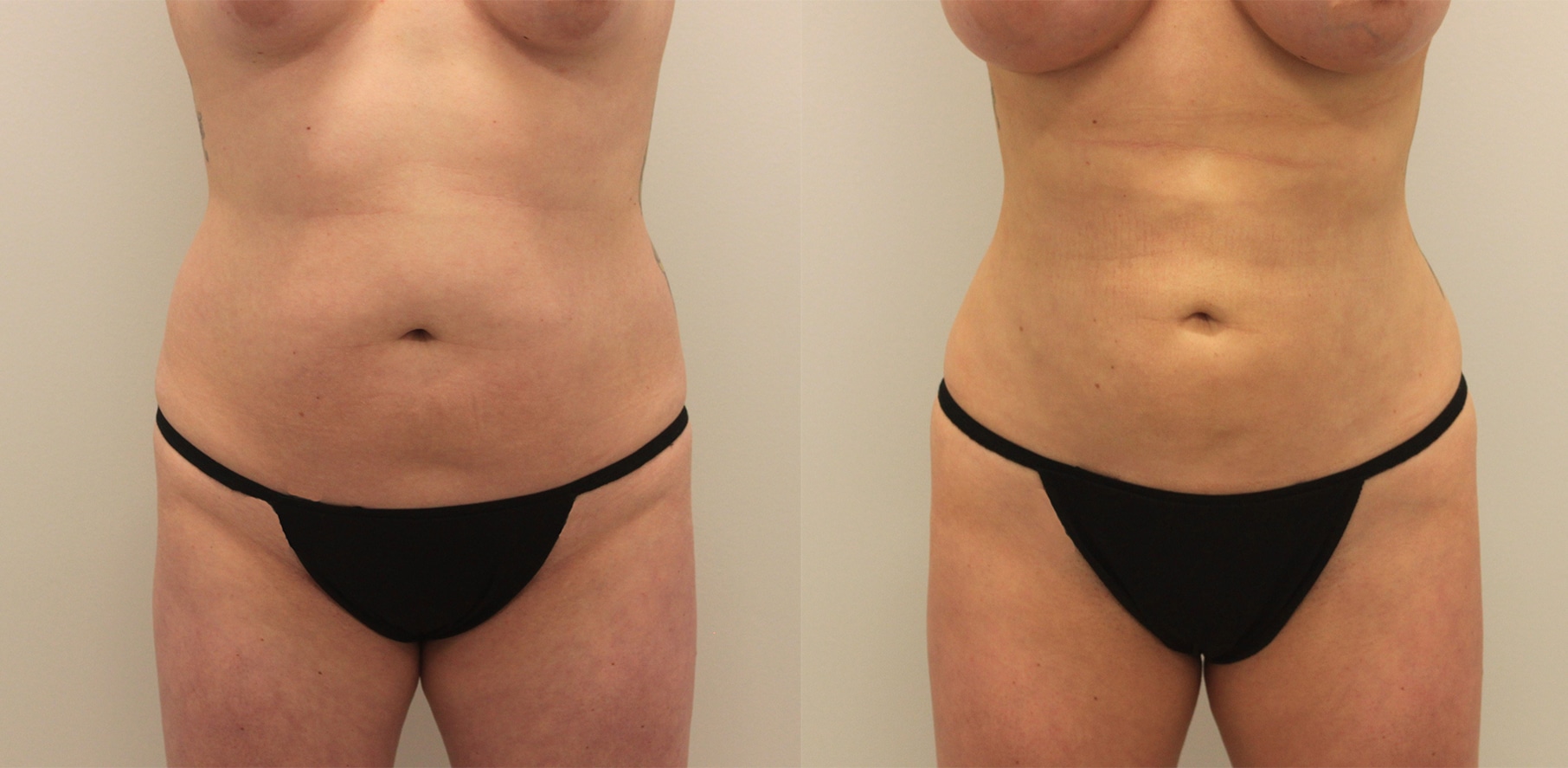 BodyTite vs. Tummy Tuck: Which Procedure is Best?