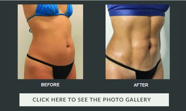 Vaser Liposuction vs Liposuction: What Is the difference?