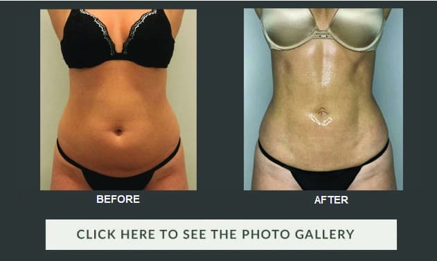 Body Contouring Using VASER-Assisted Liposuction
