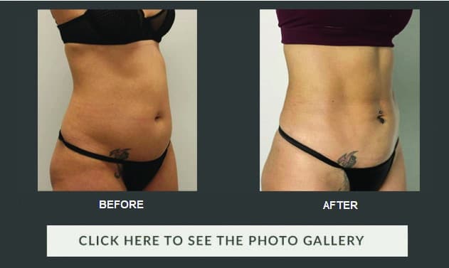 High definition body contouring for the plus size patient.