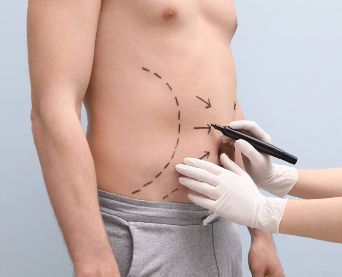 What Is a Tummy Tuck? - Dr. Kadz